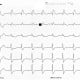 ECG © Domaine Public